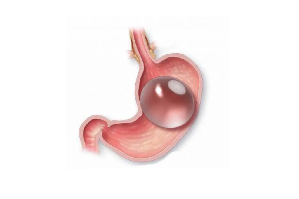 Gastric Balloon Kenya Anatomy
