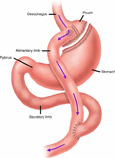 Gastric Bypass Kenya Anatomy