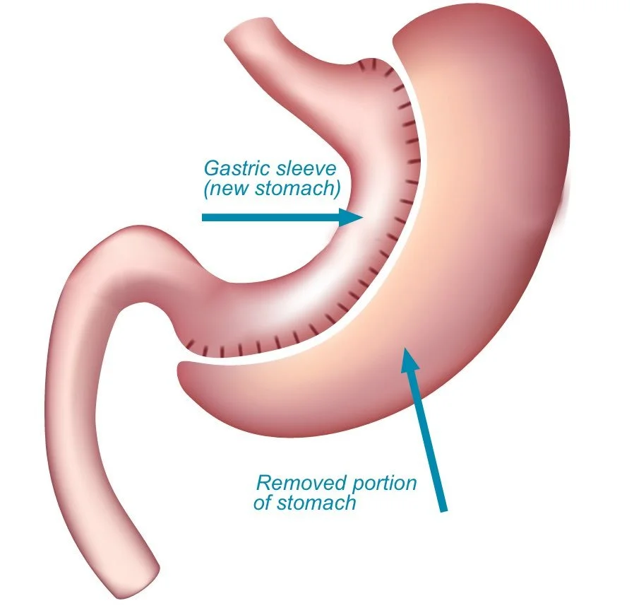 Gastric Sleeve Surgery in Kenya Anatomy