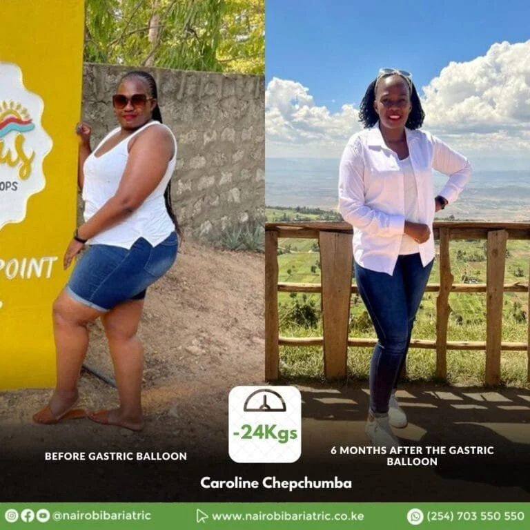 Caroline_Chepchumba_gastric_balloon_before_after