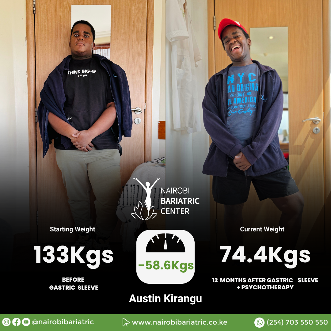 Austin Kirangu — Gastric Sleeve + PCEH