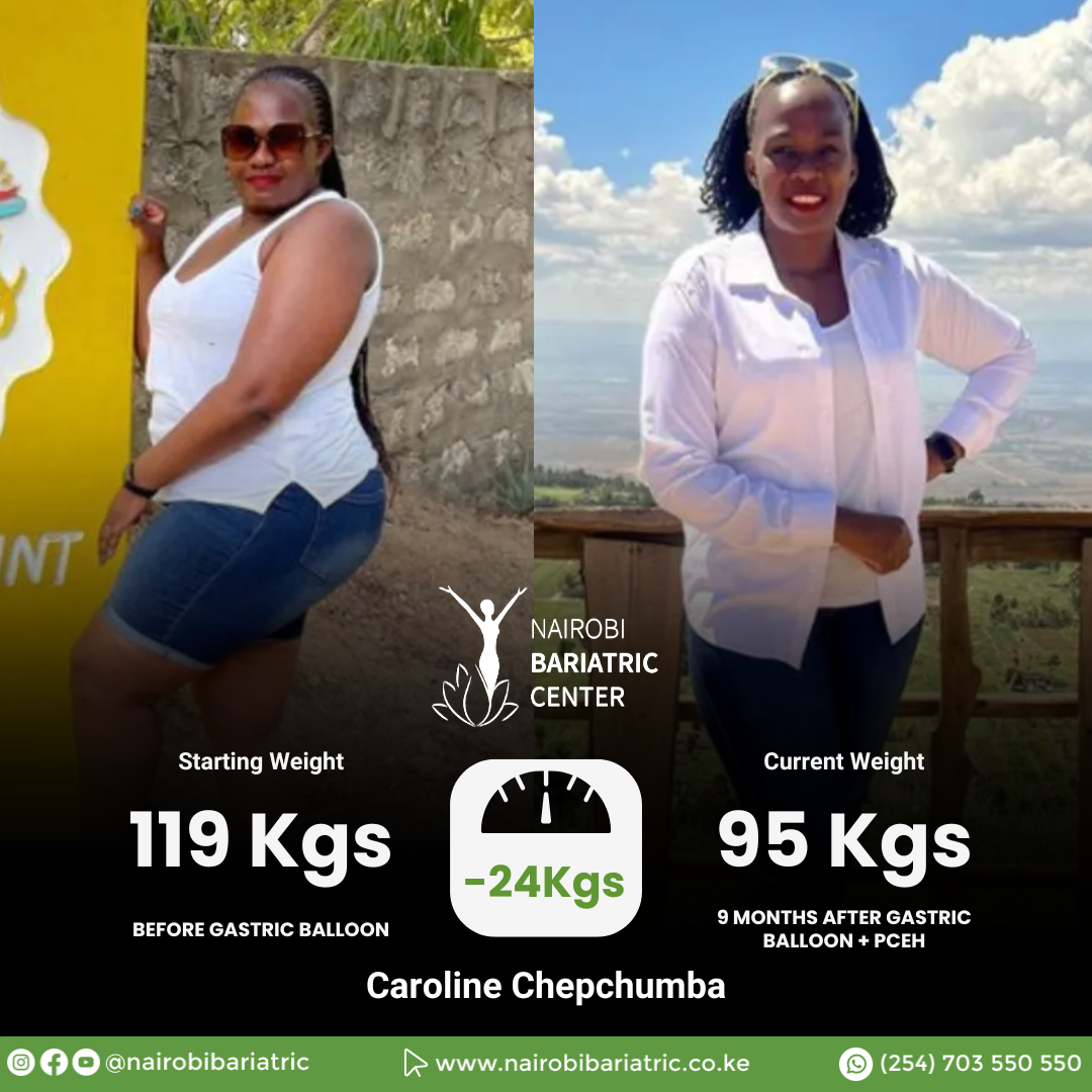 Caroline Chepchumba — Gastric Balloon