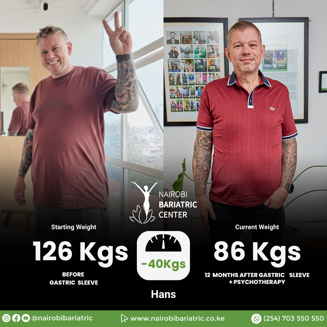 Hans — Gastric Sleeve + PCEH