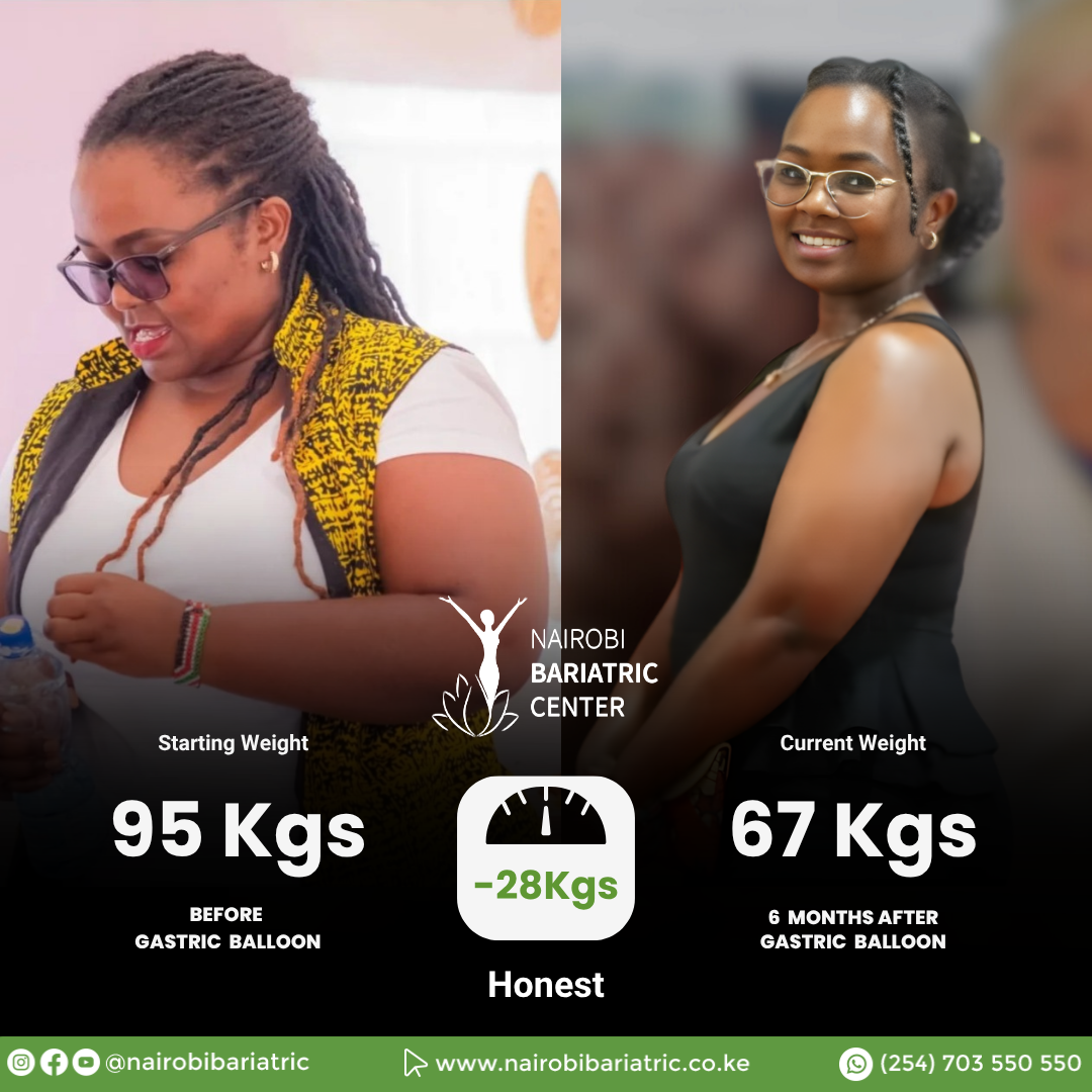 Honest — Gastric Balloon