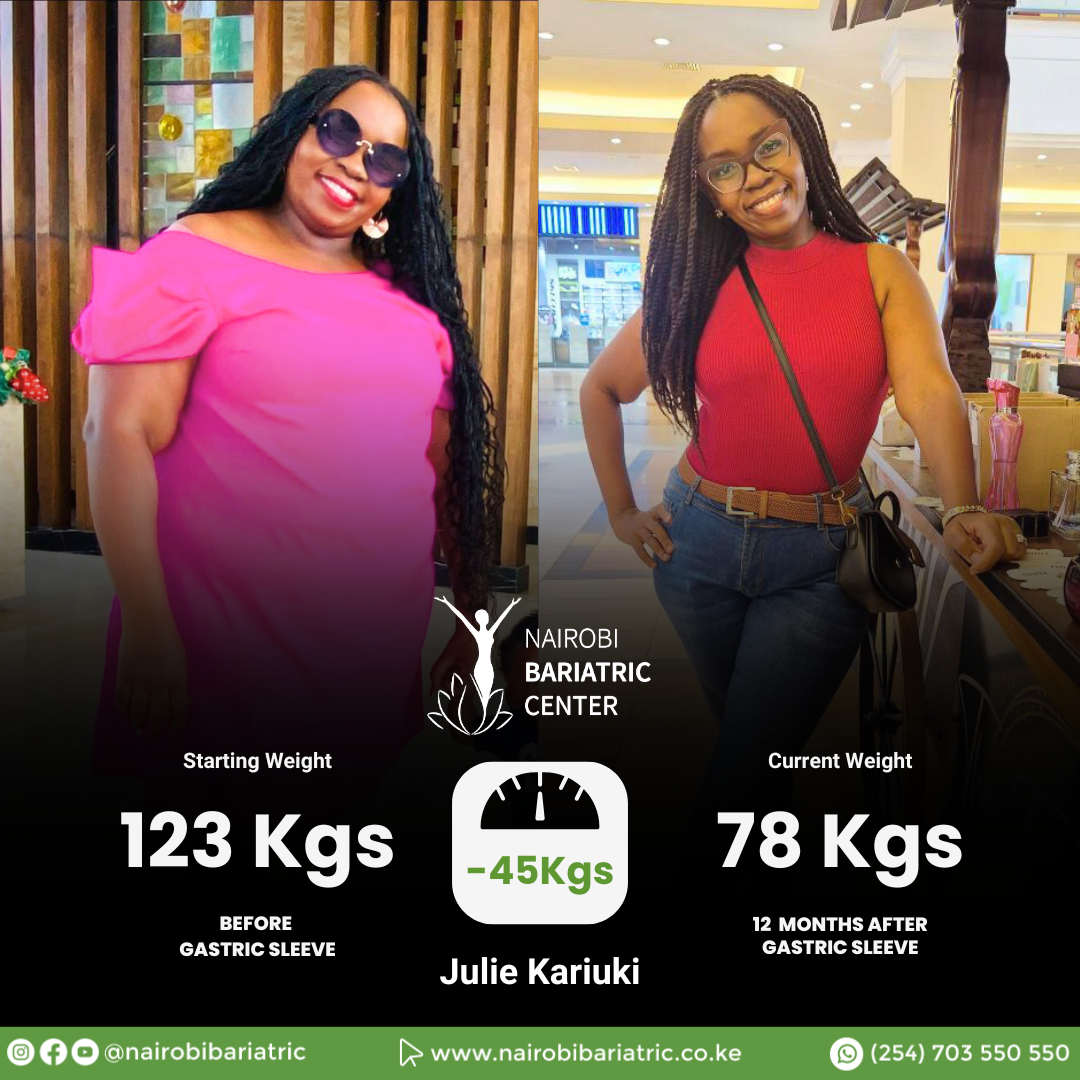 Julie Kariuki — Gastric Sleeve