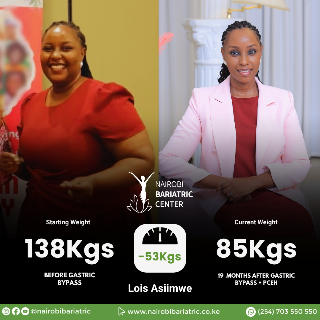 Lois Asiimwe — Gastric Bypass + PCEH