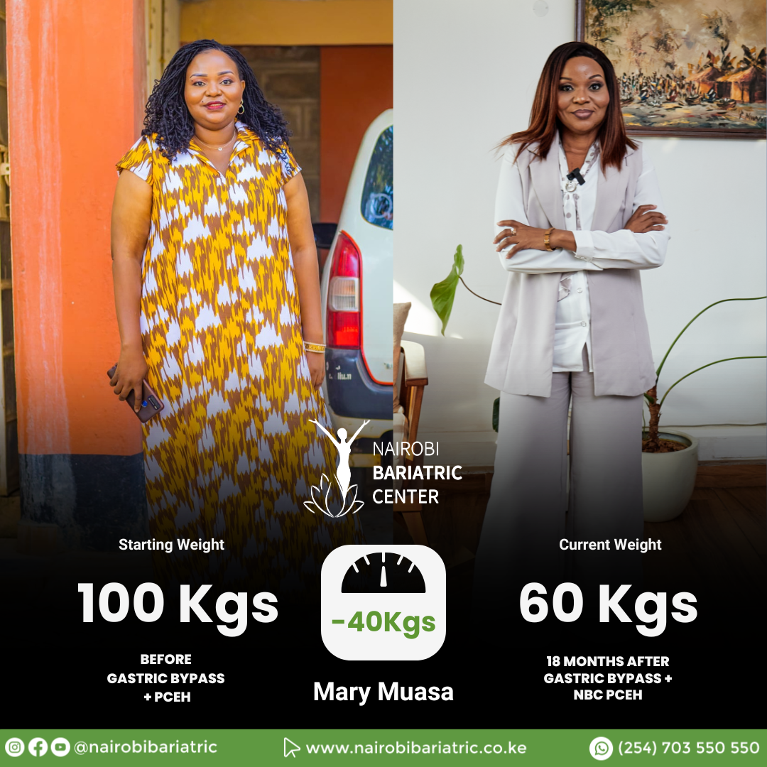 Mary — Gastric Bypass