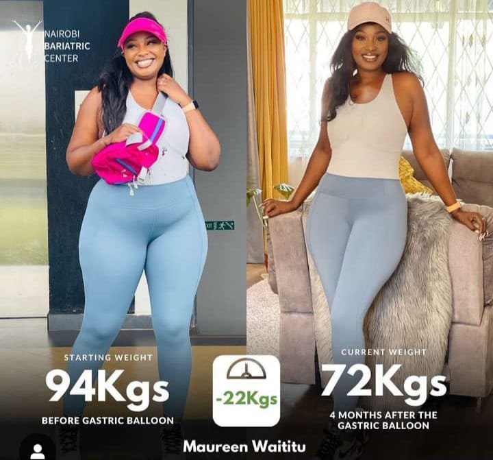 Maureen Waititu — Gastric Balloon + PCEH