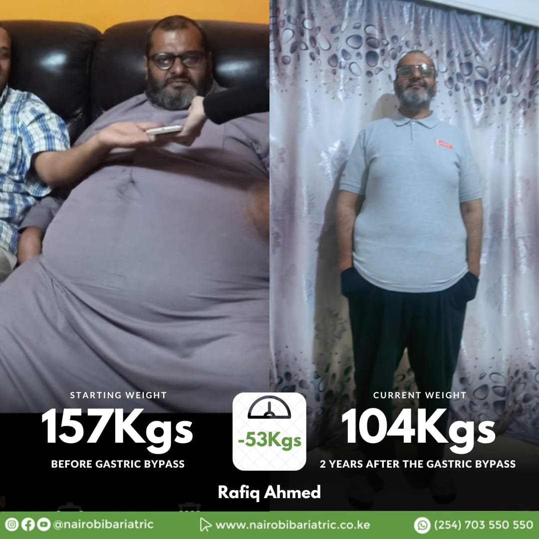 Rafiq Ahmed — Gastric Bypass + PCEH