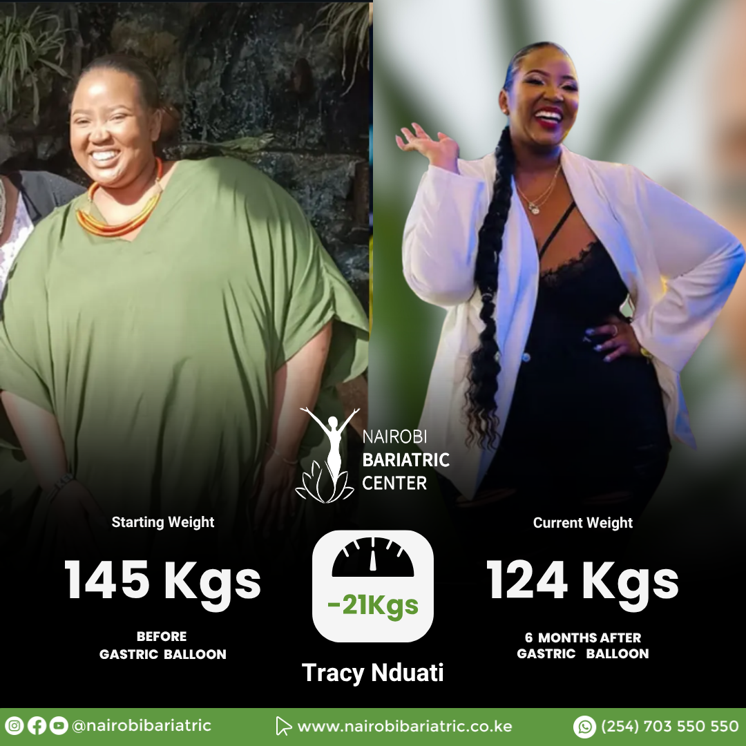 Tracy Nduati — Gastric Balloon